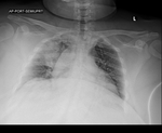 COVID-19 X-ray: Patient 1