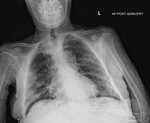 COVID-19 X-ray: Patient 3