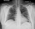 COVID-19 X-ray: Patient 4