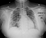COVID-19 X-ray: Patient 5