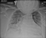 COVID-19 X-ray: Patient 6