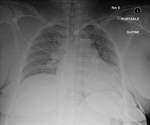 COVID-19 X-ray: Patient 7