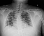 COVID-19 X-ray: Patient 8
