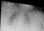 COVID-19 X-ray: Patient 9