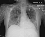 COVID-19 X-ray: Patient 10