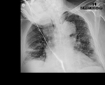 COVID-19 X-ray: Patient 11