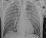 COVID-19 X-ray: Patient 12