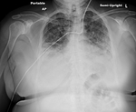 COVID-19 X-ray: Patient 14