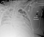 COVID-19 X-ray: Patient 17