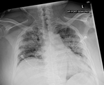 COVID-19 X-ray: Patient 20